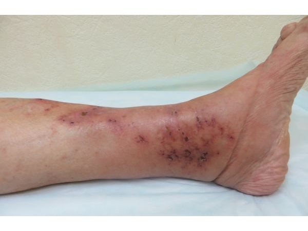 Левая голень до лечения