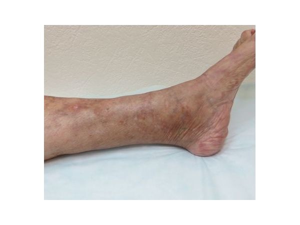 Левая голень после лечения