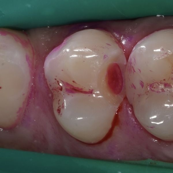 Кариес под пломбой Кариес под пломбой