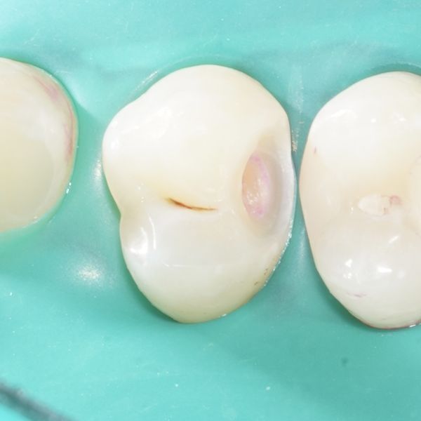 После удаления кариеса После удаления кариеса