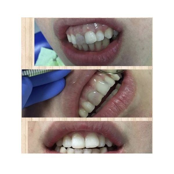 До и после лечения