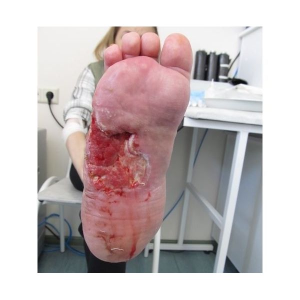 Язва в октябре 2012 года Язва в октябре 2012 года