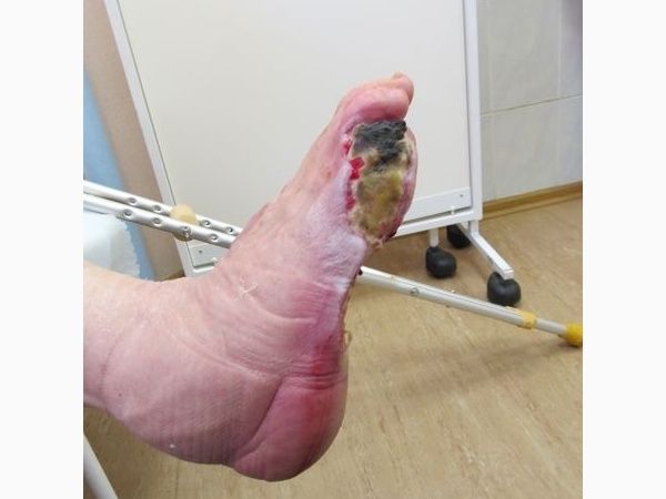 Гангрена мизинца в августе 2012 года Гангрена мизинца в августе 2012 года