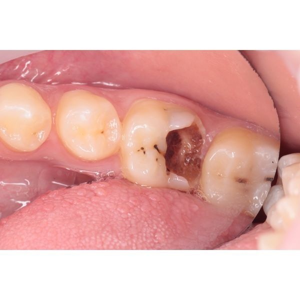 Глубокий кариес