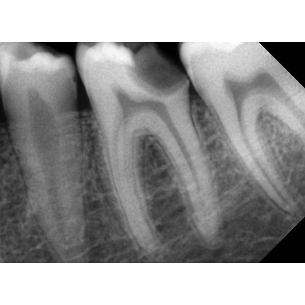 Глубокий дефект твёрдых тканей на рентгенограмме