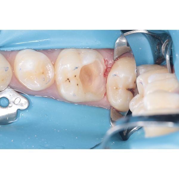 Удаление инфицированных тканей