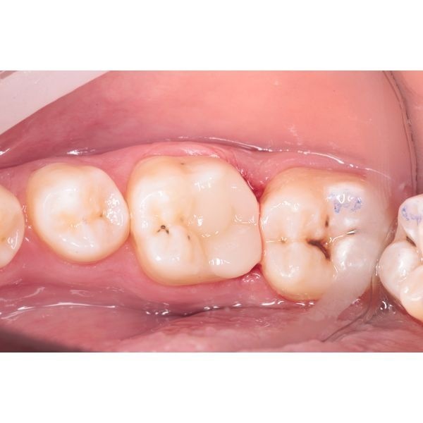 Восстановление анатомической формы зуба