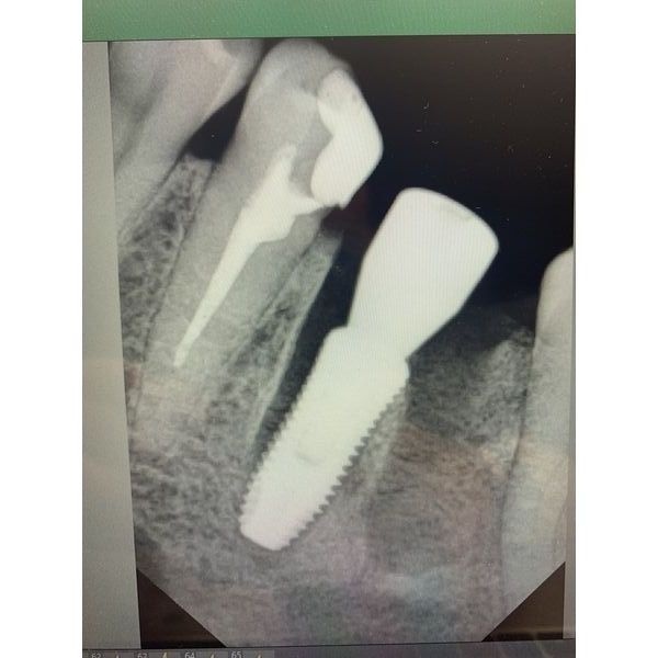 Рентген-контроль после установки импланта