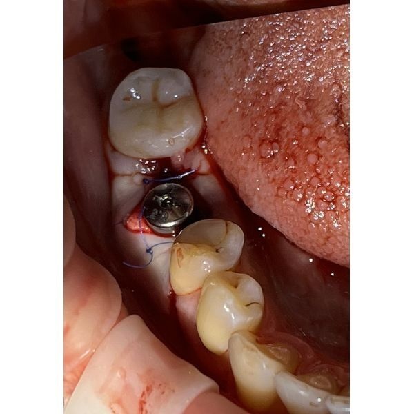 После операции