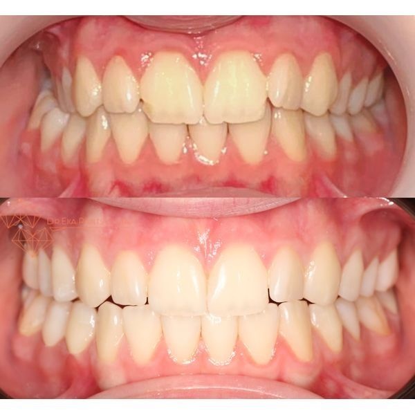 До и после лечения