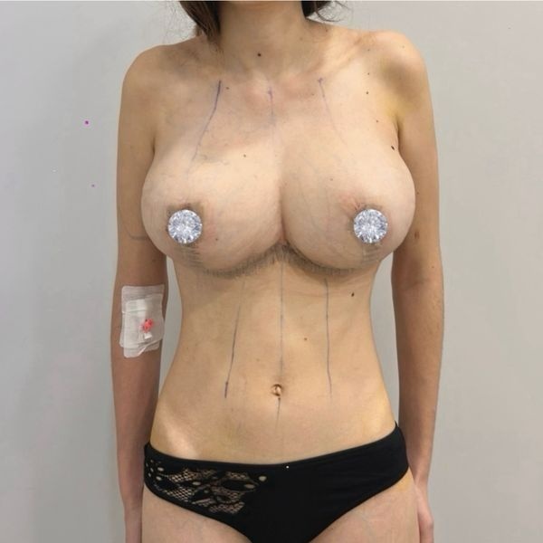 Грудь после операции Грудь после операции