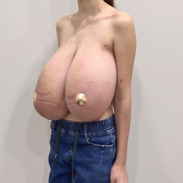 Грудь до операции Грудь до операции