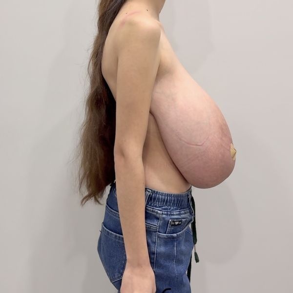 Грудь до операции Грудь до операции