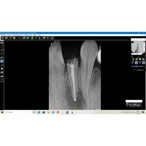 Пломбирование канала