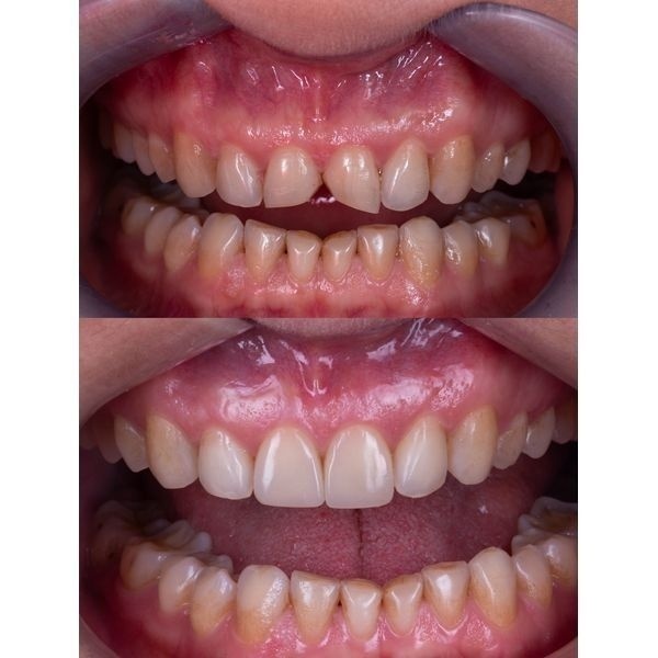 До и после окончания реставрации