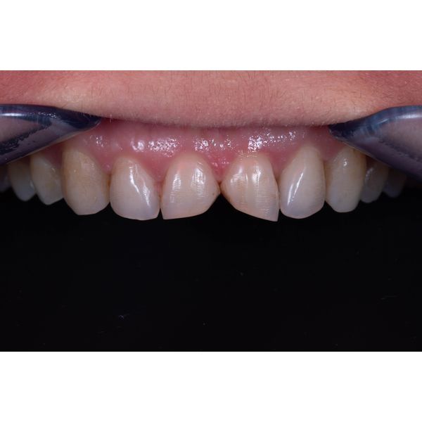 Форма резцов до лечения