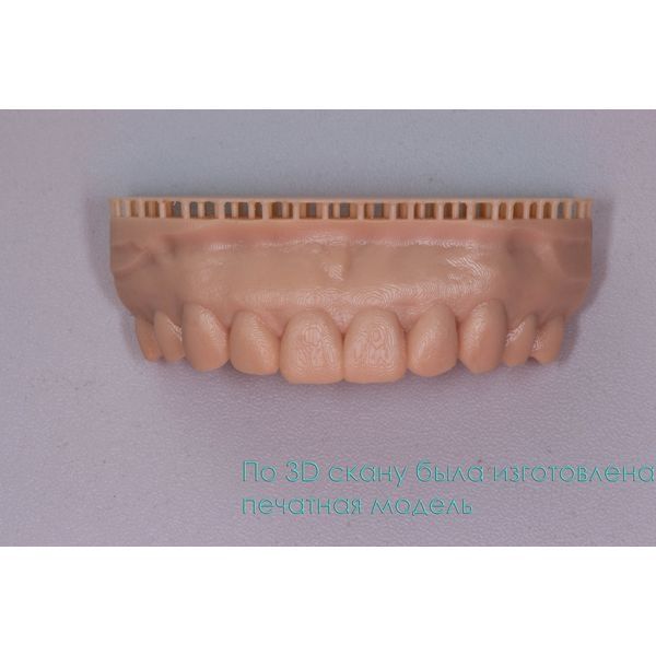 Печатная модель будущей формы и размера зубов