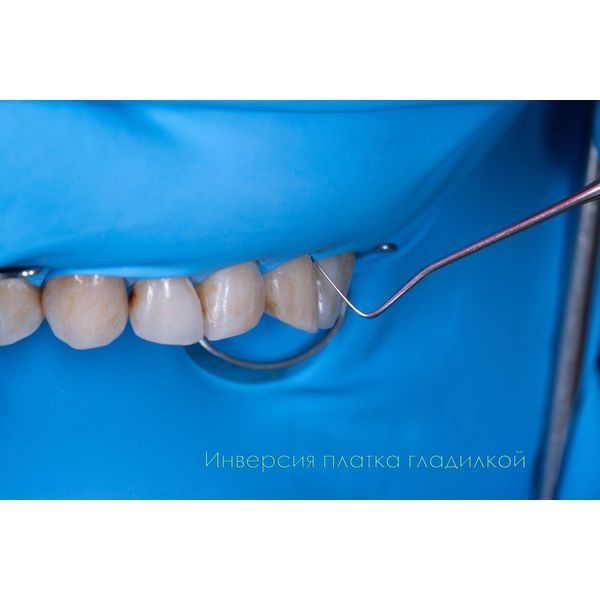 При помощи гладилки провели инверсию платка в зубодесневую борозду