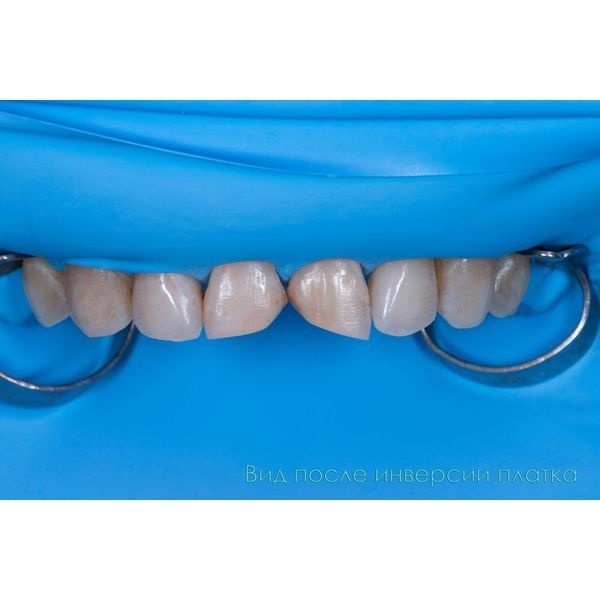 Добились абсолютной изоляции зубов после инверсии платка