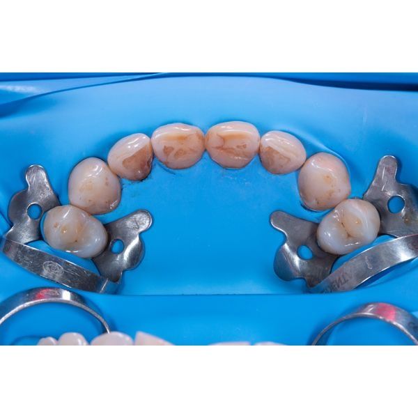 Цвет зубов до лечения