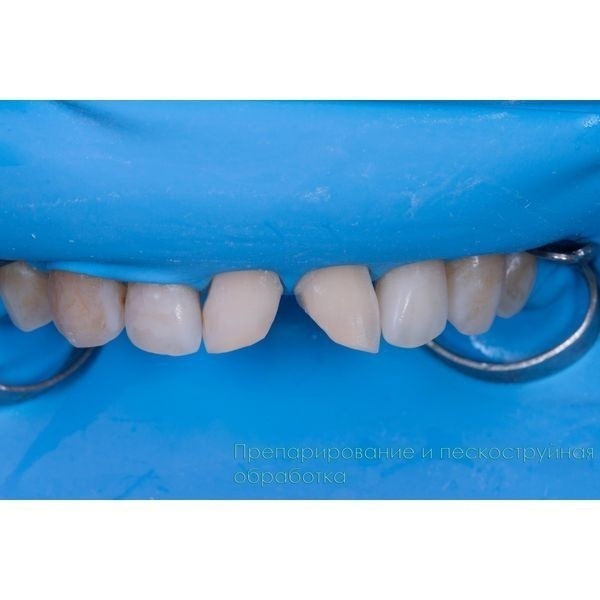 Убрали остатки старых пломб и провели пескоструйную обработку 