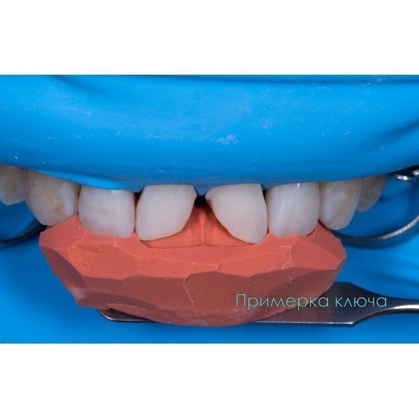 Силиконовый оттиск, этап примерки