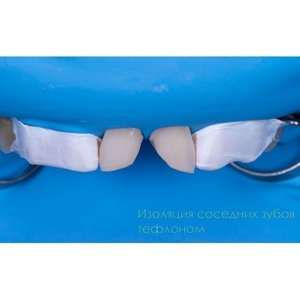 Изолировали соседние зубы тефлоном 