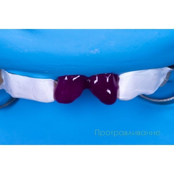 Обработали зубы специальным веществом для для протравивания, чтобы пломба максимально крепко прикрепилась к зубу