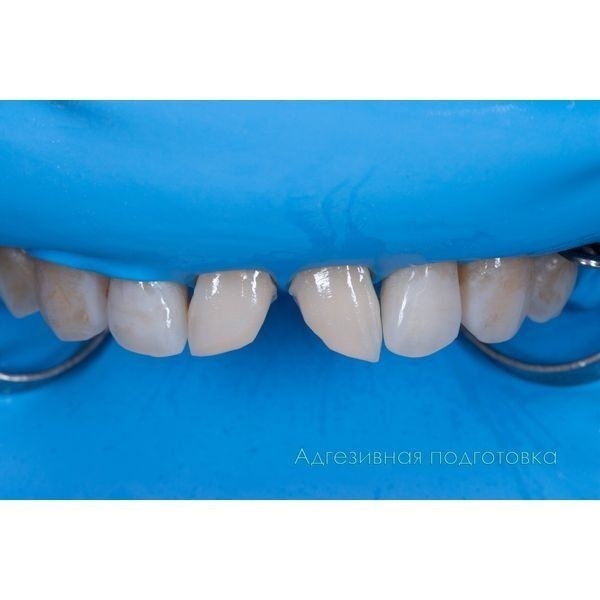 Покрыли поверхность зубов адгезивом (специальным клеем)