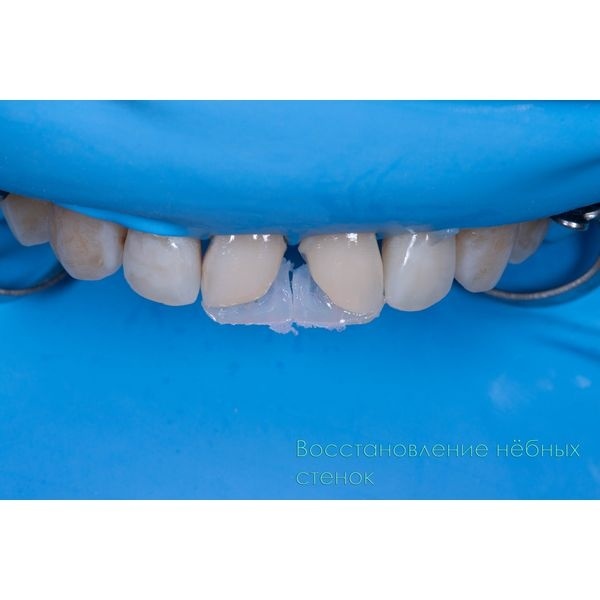 После светоотверждения заполнили все пустоты