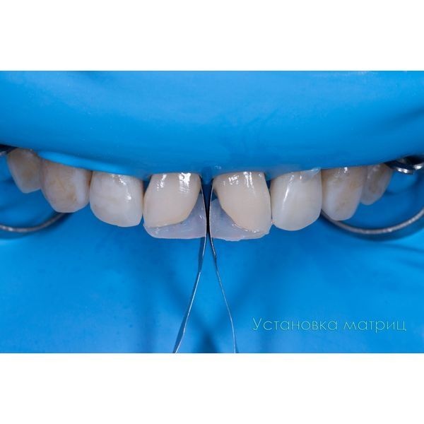 Установили специальные металлические матрицы, по ним будут формироваться контактные поверхности