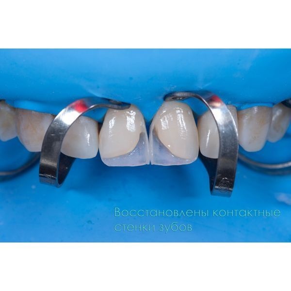 Восстановили контактные стенки зубов