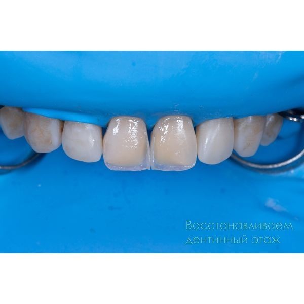 Восстанавили дентинный слой