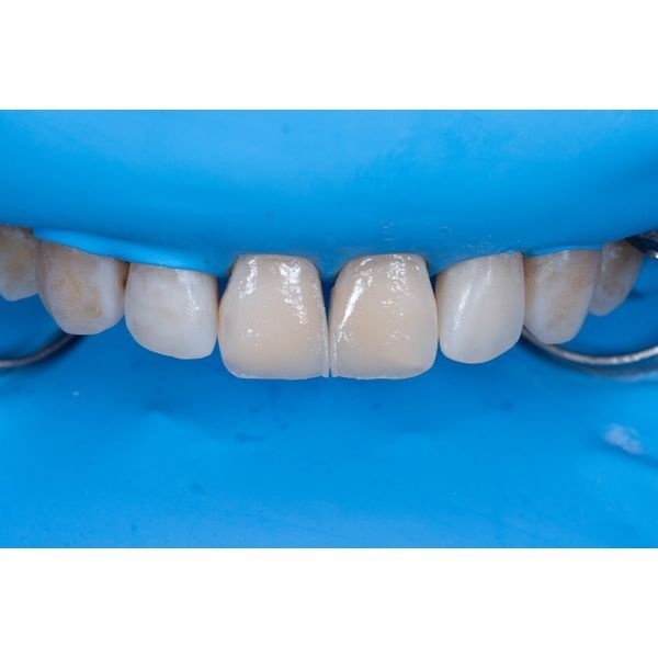 Уложили и полимеризовали прозрачный материал