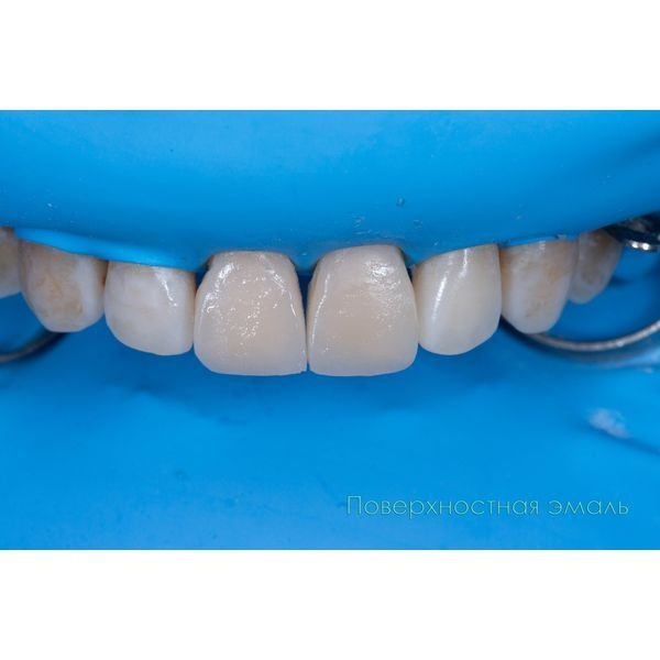 Верхний слой покрыли поверхностной эмалью 