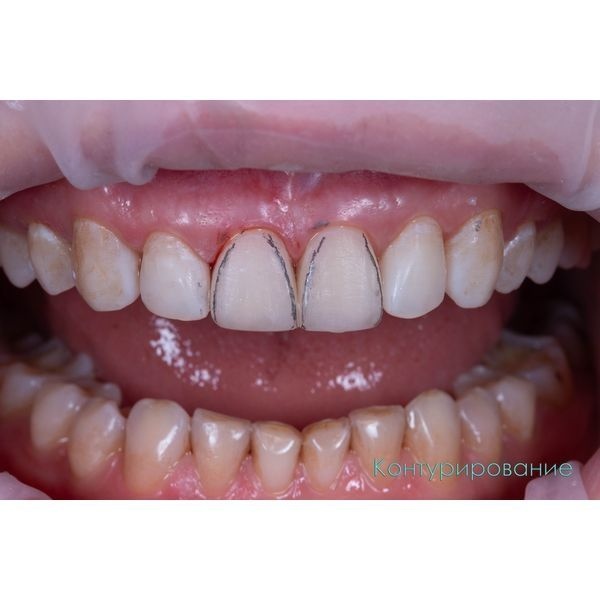 Для лучшего восприятия формы окрасили зуб карандашом