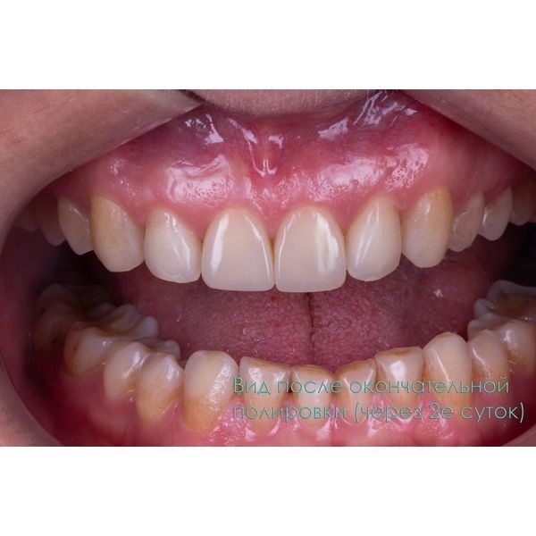 Зубы после окончательного контурирования и полировки. Длину одного из резцов затем скорректировали