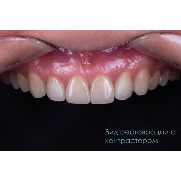 Окончательный вид зубов после реставрации