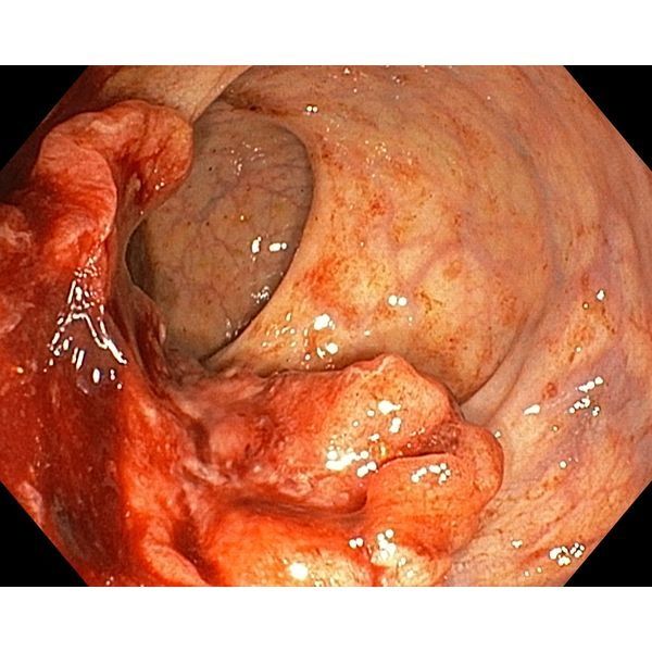 Онкологический процесс, выявленный при колоноскопии