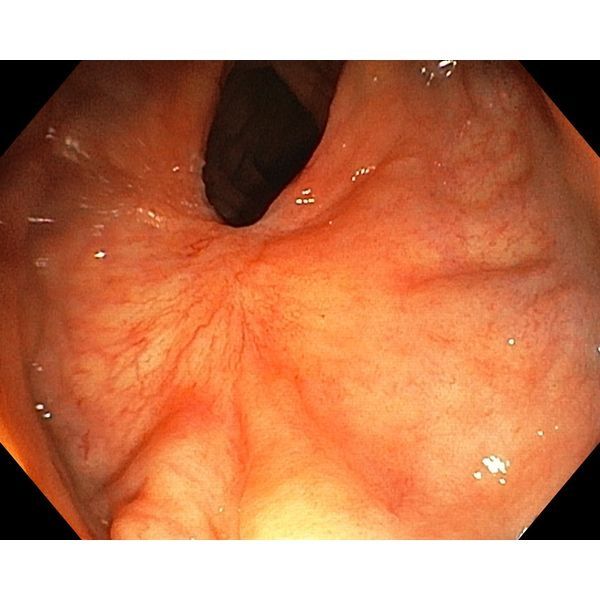 Контрольная колоноскопия: рубец в области ранее выявленной опухоли