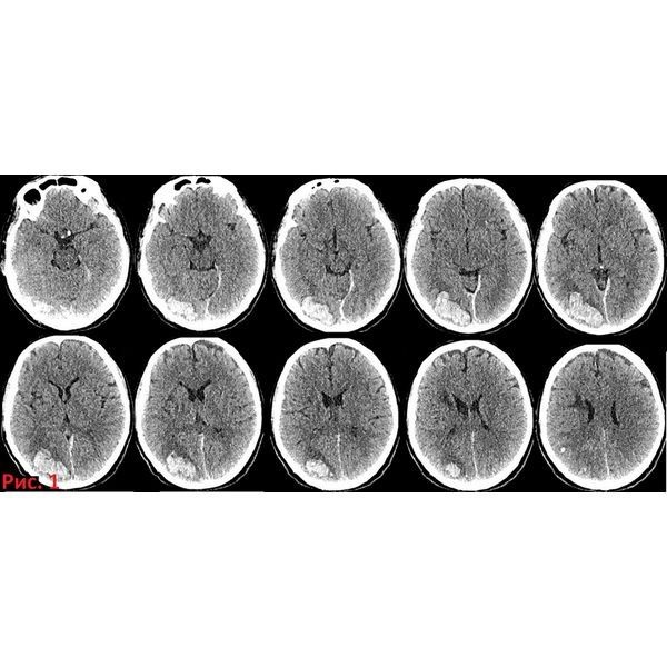 КТ головного мозга. Подострая внутримозговая гематома правой затылочной области