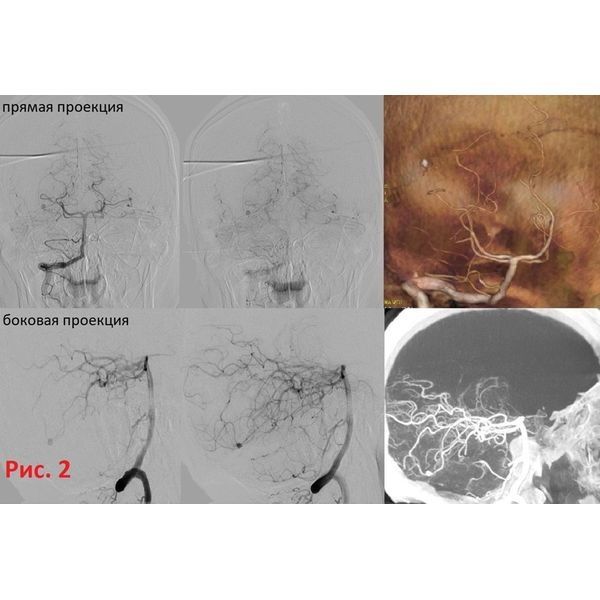 КТ-ангиография и прямая церебральная ангиография. Дистальная аневризма шпорной ветви правой задней мозговой артерии