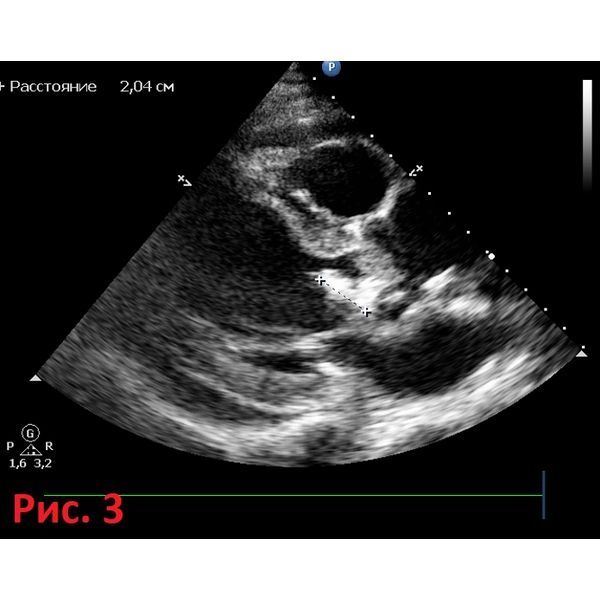 Дилатация левых отделов сердца