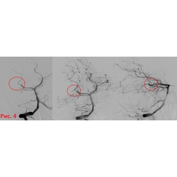 Окклюзия задней мозговой артерии микроспиралями Target