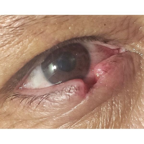 Состояние нижнего века на момент обращения