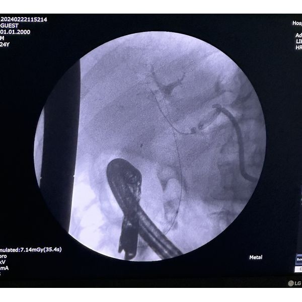 Интраоперационная фистулохолангиография