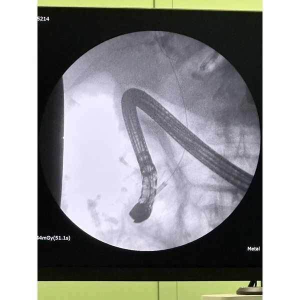 Рабочая часть аппарата SpyGlass при рентенологическом исследовании