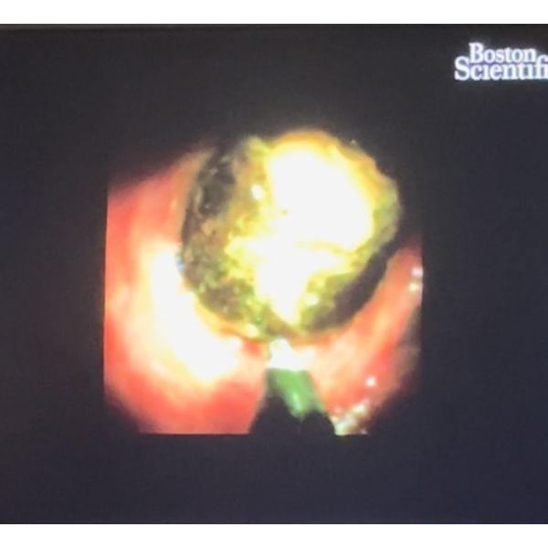 Конкремент холедоха