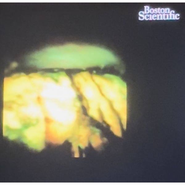 Холедохолитотрипсия