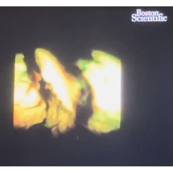 Непосредственная холедохолитотрипсия